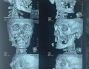  Хирурги заново собрали лицо мужчине, который выжил после встречи с медведем